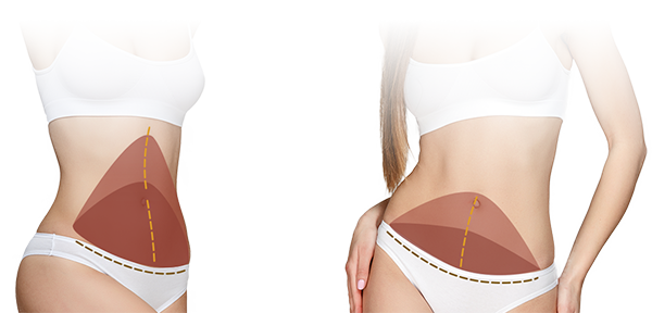 Tummy Tuck Infographic