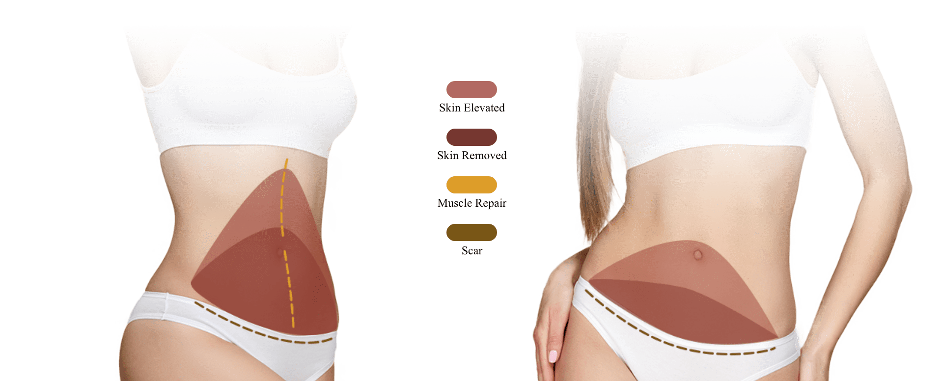 Full vs. Mini Tummy Tuck